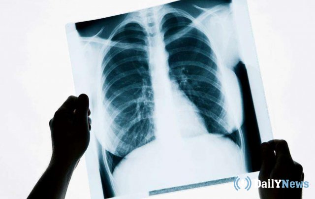 Проект по принудительному лечению от туберкулеза планируют запустить в России