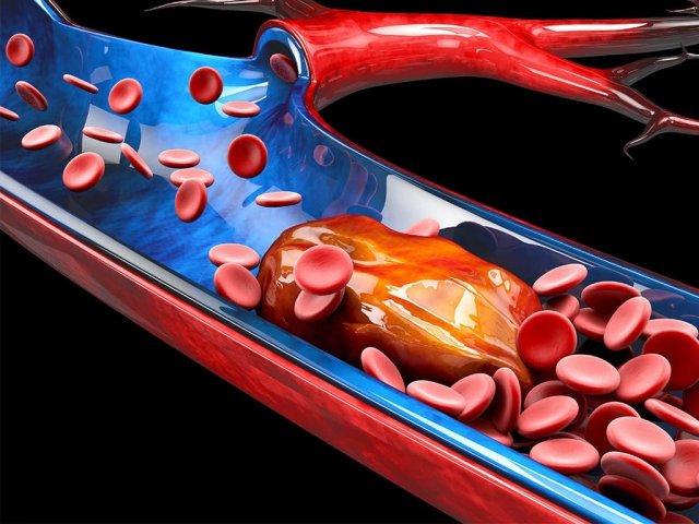 Врачи перечислили основные признаки артериального тромбоза