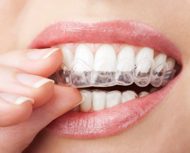 Эксперты рассказали о том, какие существуют мифы о домашнем отбеливании зубов