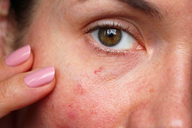 Эксперт предупреждает об опасности красных сеточек на лице