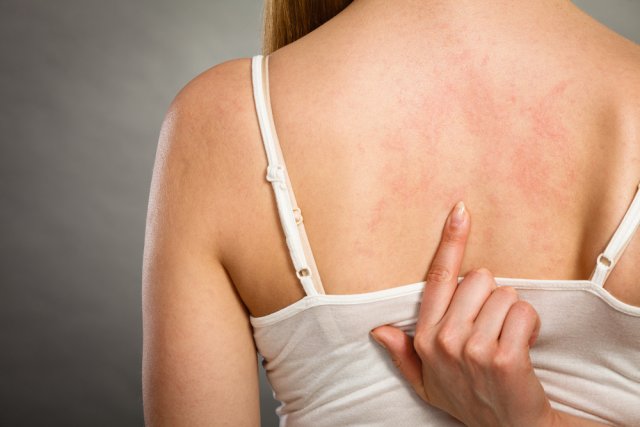 Эксперт дал рекомендации о том, как спасти человека при внезапном приступе аллергии