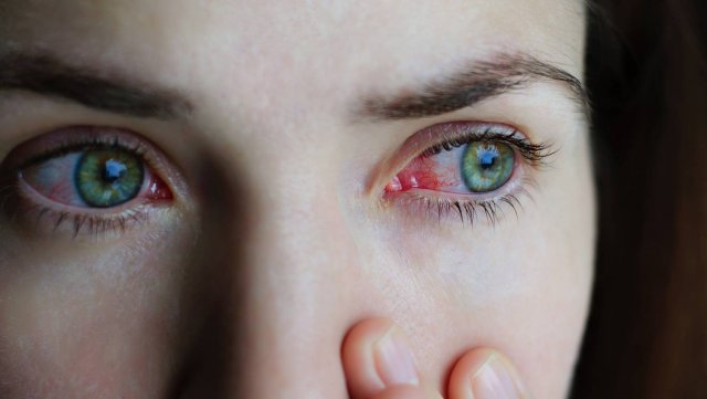 Офтальмолог предупреждает, что покраснение глаз является опасным синдромом