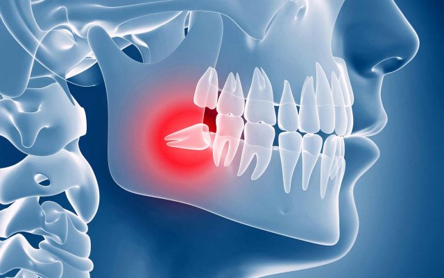 Стоматолог рассказал об опасности зубов мудрости