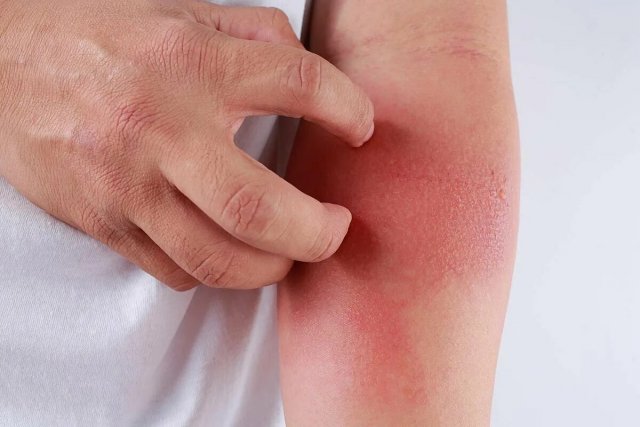 Как снизить обострение кожных заболеваний в осеннее время
