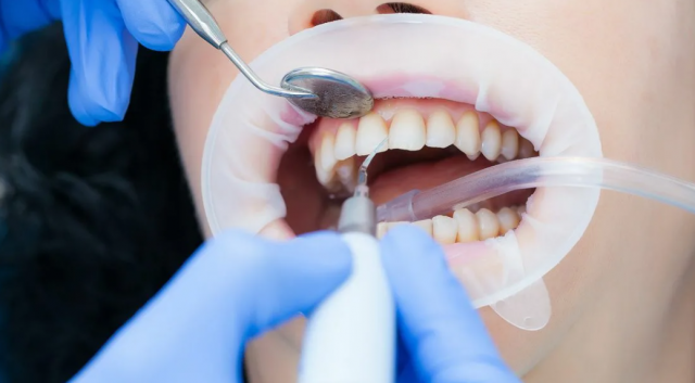 Стоматолог делится советами по домашнему отбеливанию зубов