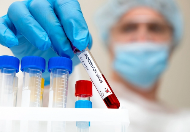 В Роспотребнадзоре контролируют случай оспы обезьян в Петербурге